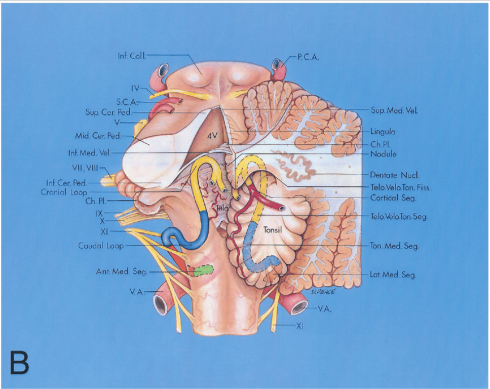 Enlarged posterior view. The left and part of the right halves of the cerebellum was removed to show the relationship of the PICA to the roof of the fourth ventricle.
