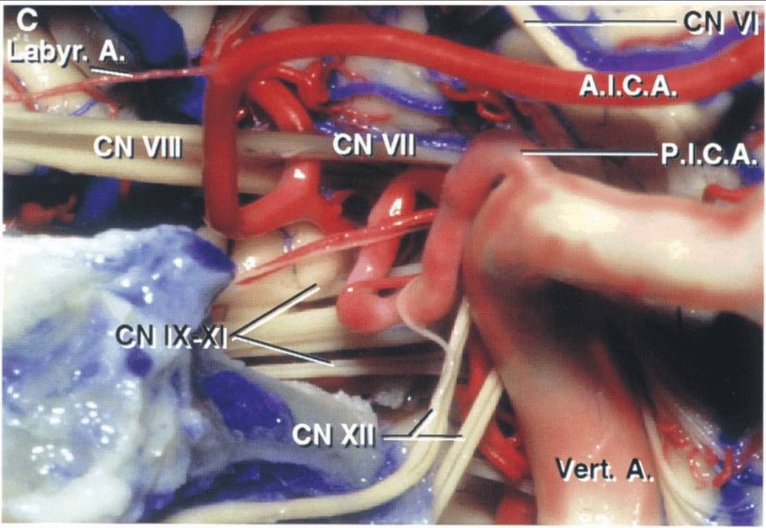Another enlarged view of the right cerebellopontine angle