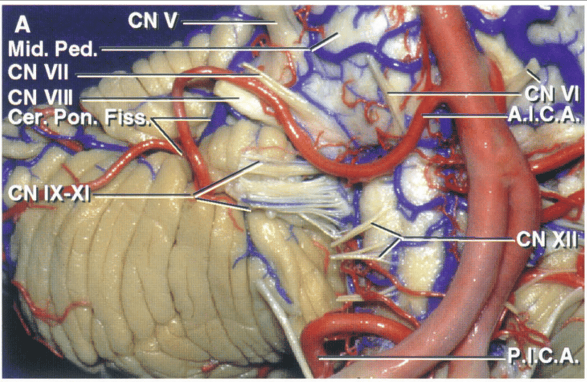 Anterolateral view of the brainstem and right petrosal cerebellar surface