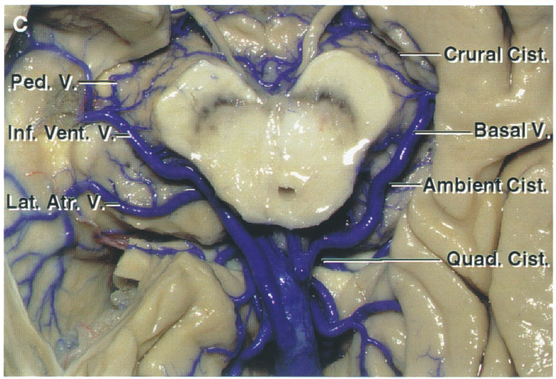 InfÅ}e Crural is Basal V mbi is , Cist 