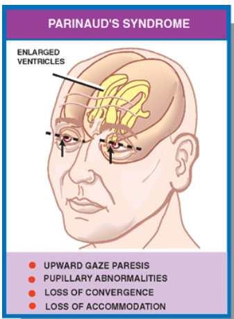 PARINAUDS SYNDROME UPWARD GAZE PARESIS PUPILLARY ABNORMALITIES Loss OF CONVERGENCE LOSS OF 