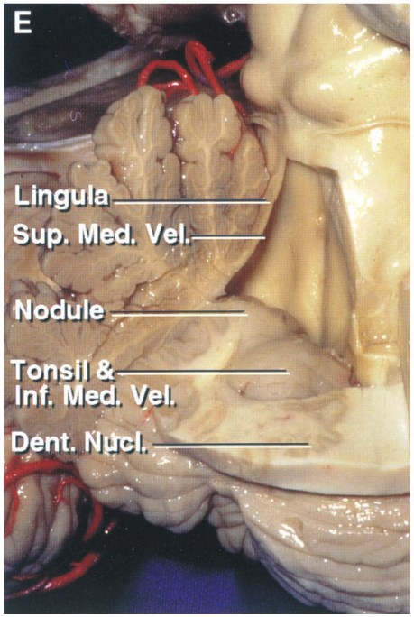 Lingulö Sup. Med. el. Nodulee Tonsif'ö Inf. Med. Yell fnt. 