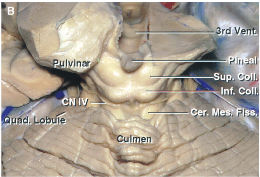 Enlarged view of the cerebellomesencephalic fissure