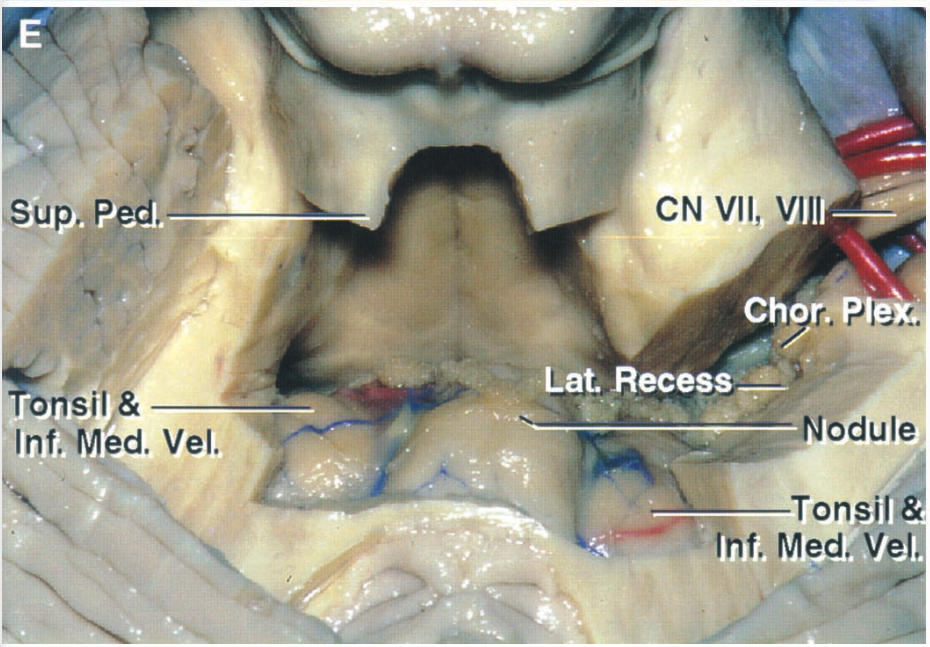 Sup.,Ped, Inf.*Med. Vel. CN Vil, VI Cho Lat. Recess •se'$NOduIe • inf. Med. Ve 
