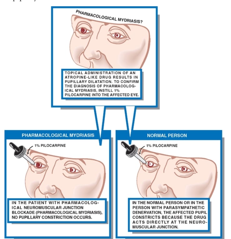 MYDRIASE? ropiCAL ADMINISTRATION OF AN ATROPINE.LIKE DRUG RESULTS IN PuPlLLARY OILATATION. TO CONFIRM THE DIAGNOSIS OF PHARMACOLOG- 'CAL MYORIASIS. INSTILL PILOCARPINE INTO THE AFFECTED EYE. PILOCARPINE IN THE PATIENT WITH PHARMACOLOG- ICAL NEUROMUSCULAR JUNCTION BLOCKADE (PHARMACOLOGICAL MYDRIANS), NO PUPILLARY CONSTRICTION OCCURS. BLOCARPINE IN THE NORMAL PERSON OR IN THE PERSON WITH PARASYMPATHETIC DENERVATION. THE AFFECTED PUPIL CONSTRICTS BECAUSE THE DRUG ACTS DIRECTLY AT THE NEURO- MUSCULAR JUNCTION 