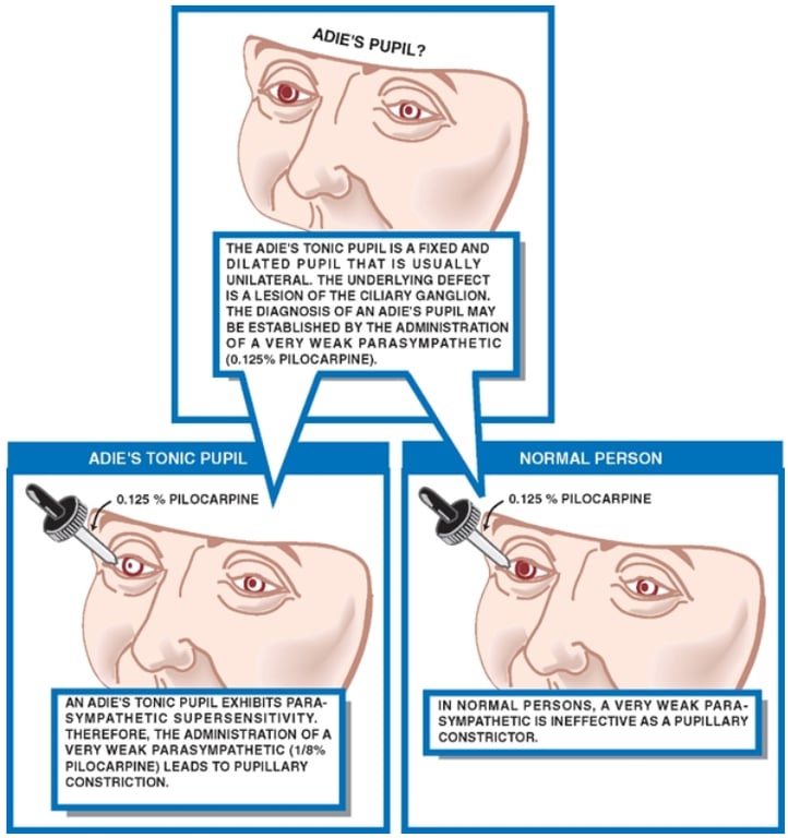 ADIE •s PUPIL? THE ADIE'S TONIC PUPIL IS A AXED AND DILATED PUPIL THAT IS USUALLY UNILATERAL. THE UNDERLYING DEFECT IS A LESION OFTHE GANGLION. THE DIAGNOSIS OF AN PUPIL MAY BE ESTABLISHED BY THE ADMINISTRATION OF A VERY WEAK PARASYMPATHETIC (0.12-5% 0.125 % PILOCARPINE AN ACE'S pun EXHIBITS PARA. SYMPATHETIC SUPERSENSITIVITY. THEREFORE, THE ADMINISTRATION OF A VERY WEAK PARASYMPATHETIC PILOCARPINE) LEADS TO PUPILLARY CONSTRICTION. O. •S PILOCARPNE IN NORMAL PERSONS. A VERY WEAK PARA- SYMPATHETIC INEFFECTIVE AS A pumLLARY 