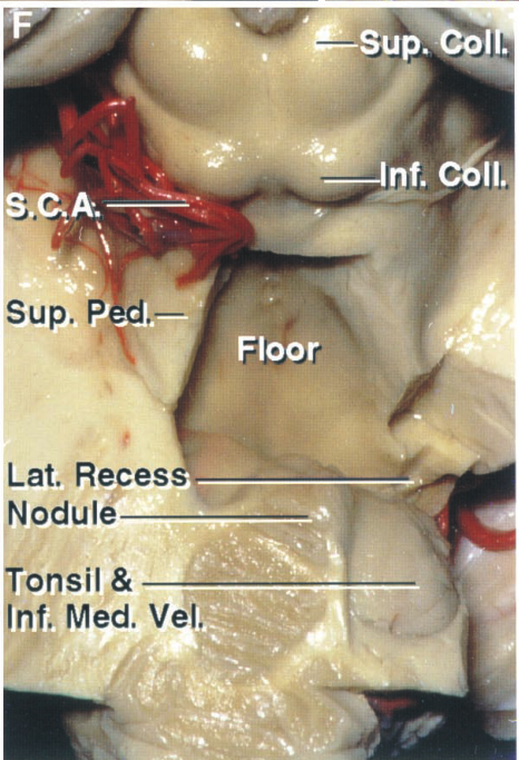 %4Sup.— sup. P d.— Floor Lat. Reces Nodule Tonsil & In'. Med. Vel.• 