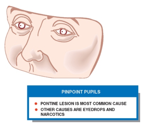 PINPOlNT PUPILS • ромтжЕ LESIOH ISMOST СОММОН CAUSE . отнея HARCOTICS 