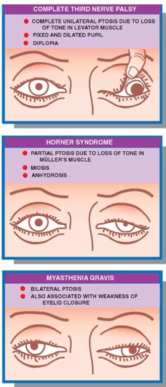 COMPLETE THIRD NERVE PALSY . COMPLETE UNILATERAL pros'S DUE TO Loss OF TONE IN LEVATOR uuscLE • FIXED ANOORATEO DIPLOPIA HORNER sy NDROME PARTIAL *Toes TO Loss OF TONE IN MUSCLE AWYORO*S 6) MYASTHENIA GRAVIS BILATERAL PTOS4S • ALSO ASSOCIATED WEAKNESS OF EYELID CLOSURE 