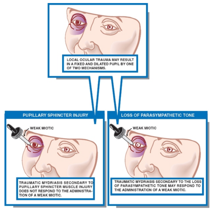 LOCAL OCULAR TRAUMA MAY RESULT IN A FIXED AND DILATED PUPIL BY ONE OF TWO MECHANISMS. WEAK wonc TRAUMATIC MYOPIAS'S SECONDARY T PUPILLARY SPHINCTER MUSCLE INJURY DOES NOT RESPOND TO THE AOWNISTRA. TION OF A WEAK WOTIC. WEAK wonc TRAUMATIC UYORIASIS SECONDARY TO THE LOSS OF PARASYMPATHETIC TONE MAY RESPOND TO THE AOWNISTRATION OF A WEAK wonc. 