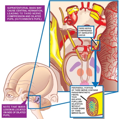 suPRATENToRlAL MASS MAY CAUSE CENTRAL HERNIATION. LEADING TO THIRD NERVE COMPRESSION AND DILATED PUPIL (HUTCHINSON'S PUPIL) NOTE THAT MASS LESION IS LOCATED ON SIDE OF CLAYED PUPIL NERVE COMPRESSED e v HERNIATED PERIPHERAL PORTION OF THIRD NERVE CONTAINS FIBERS, TM us ISOLATED PuPlLLARY tnATAnoN WITH OUT OTHER SIGNS OF THRO NERVE PALSY 