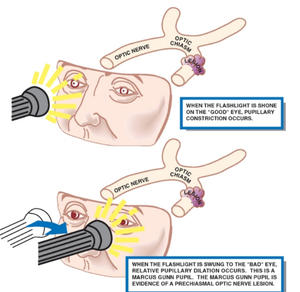 WHEN ТН€ FLASHUGHT SHONE ОМ тне •GOOO• ЕМЕ, СОНЗТЮСТЮН OCCURS. WHE'•• УНЕ FLASHUGHT В swUNG ТО тнЕ ЕМЕ. HELATIVE pup1LLARY OCCURS. А MARcus PuPIL. тнЕ MARCUS GUNN Рит 0F А PRECHIASMAL орис NERVE [Еыом 