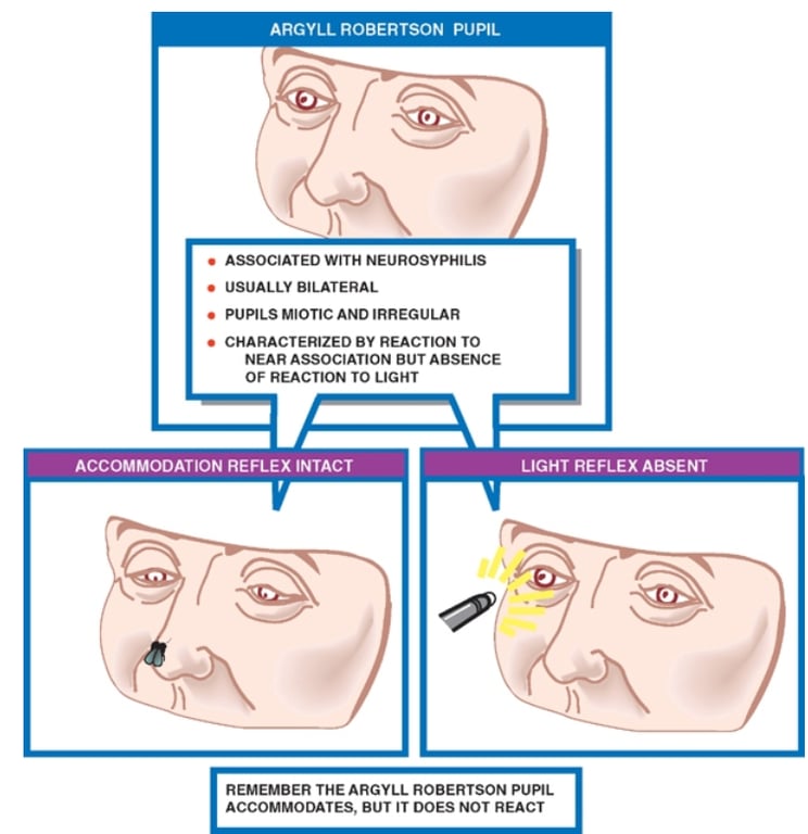 ARGYLL ROBERTSON PUPIL • ASSOCIATED WITH NEUROSYPHIUS • USUALLY BILATERAL • PUPILS AND IRREGULAR • CHARACTERIZED BY REACTION TO NEAR ASSOCIATION BUT ABSENCE OF REACTION TO LIGHT REMEMBER THE ARGYLL ROBERTSON PUPIL ACCOMMODATES, BUT IT DOES NOT REACT 