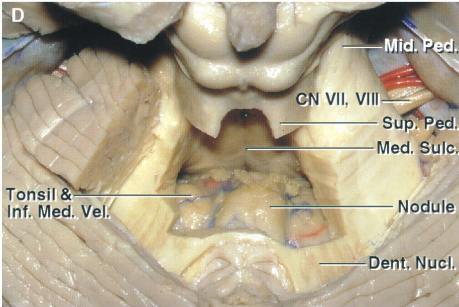 id. VII, ed. Tonsil & -Inf. M d. Vel. Med. Sul Nodule Denti Nucl 