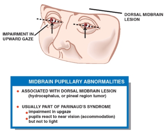 DORSAL MIDBRAIN IMPAIRMENT IN UPWARD GAZE MIDBRAIN PUPILLARY ABNORMALITIES • ASSOCIATED WITH DORSAL MIDBRAIN or pineal region tumor) • USUALLY PART OF PARINAUDSSYNDROME . Impairment in upgaze pupils react to vision (accommodation) but not to light 