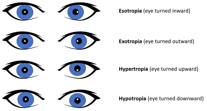 Esotropia (eye turned inward) Exotropia (eye turned outward) Hypertropia (eye turned upward) Hypotropia (eye turned downward) 