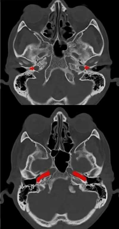 Carotid canal + It's a passage within petrous temporal bone & transmits the ICA & sympathetic plexus enters the MCF from the neck. Its initially directed superiorly, then turns anteromedially to reach up to the petrous apex. * It approximately runs 2cm and opens to foramen lacerurn. CAROTID CAW JUGULAR FORA%N FORAMEN MAGNUM CRIBRIFOU 