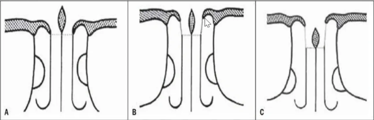 Schematic representation of the three types of olfactory fossae according to the Keros classification: A, type I, B, type II, C, type III.