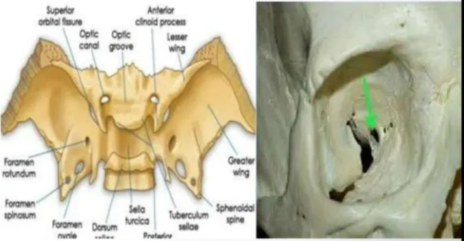 Meckers Cave # Dural invagination at posterior aspect Of cavernous sinus. Contains gasserian ganglion (trigeminal). + Dural layers shows thin peripheral enhancement. Optic canal + Formed by the lesser wing of sphenoid. + The contents are :- Optic nerve . Ophthalmic Artery. Sympathetic fibers from carotid plexus 