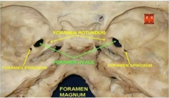 Foramen Rotundum + Canal in the base of the greater sphenoid wing, situated - inf & lateral to SOF. + It extends obliquely forward & slightly inferiorly, connecting the MCF to pterygopalatine fossa. + Transmits the maxillary nerve ( V2), artery of the foramen Rotundum & emissary veins. Foramen ovale + situated post-lat to F. rotundum + Contents : l) Mandibular Nerve (CN V3) 2) Accessory meningeal artery 3) Lesser petrosal nerve 4)Emissary vein 