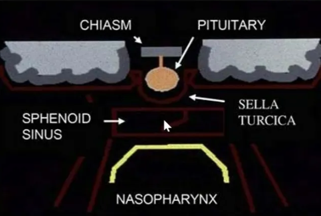 Midline sagittal compartment • Includes the body of the sphenoid and the portion Of the clivus anterior to the spheno- occipital synchondrosis (basisphenoid), • contains the sphenoid sinus, and • bordered superiorly by the sella turcica and inferiorly by the roof and posterior wall Of the nasopharynx CHIASM SPHENOID SINUS PITUITARY SELLA NASOPHARYNX 