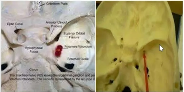 Foramen Rotundum + Canal in the base of the greater sphenoid wing, situated - inf & lateral to SOF. + It extends obliquely forward & slightly inferiorly, connecting the MCF to pterygopalatine fossa. + Transmits the maxillary nerve ( V2), artery of the foramen Rotundum & emissary veins. Foramen ovale + situated post-lat to F. rotundum + Contents : l) Mandibular Nerve (CN V3) 2) Accessory meningeal artery 3) Lesser petrosal nerve 4)Emissary vein 