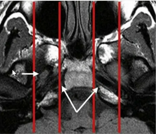 e lateral compartments • formed by sphenoid triangle, squamous part of ternporal bone, and temporomandibular joint. 