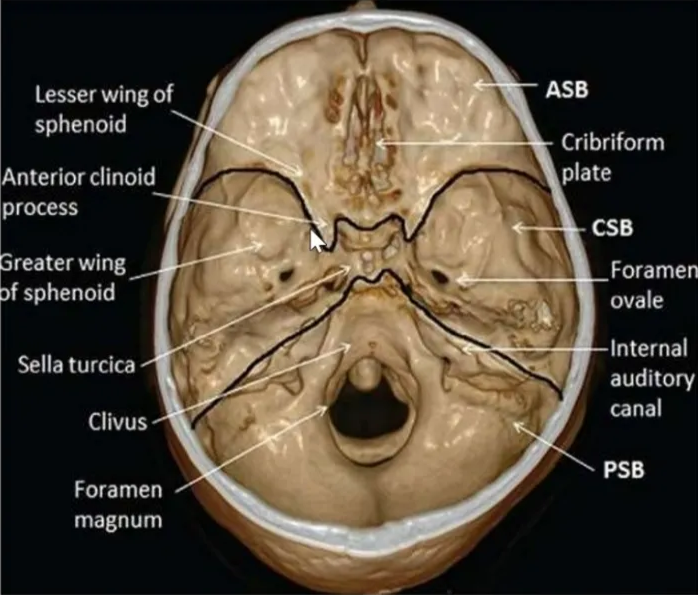 Central Skull base (Middle cranial fossa) • The CSB makes up the floor of the middle cranial fossa. Lesser Of • The sphenoid bone contributes to the most of the CSB. • Anterior border -tuberculum sellae, anterior clinoid process, posterior margin of lesser wing of sphenoid & anterior superior rim of greater wing Of sphenoid. • Posterior border : - -superior border of petrous part of temporal bone and the dorsum sellae of sphenoid. reater wing sphendd Interna' auditor V 