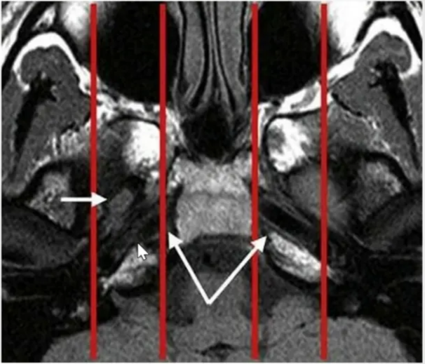 The Para sagittal compartments • It includes the petroclival synchondrosis, foramen lacerum, and medial aspect Of the greater sphenoid wing. • It is bordered superiorly and medially by the parasellar region containing the cavernous sinus, superiorly and laterally by the basal temporal lobes, and inferiorly by the parapharyngeal and masticator spaces of the suprahyoid neck. • Many crucial neurovascular structures lay in this compartment , including cavernous sinus, superior orbital fissure, foramen rotundum, vidian canal , and foramen lacerum. 