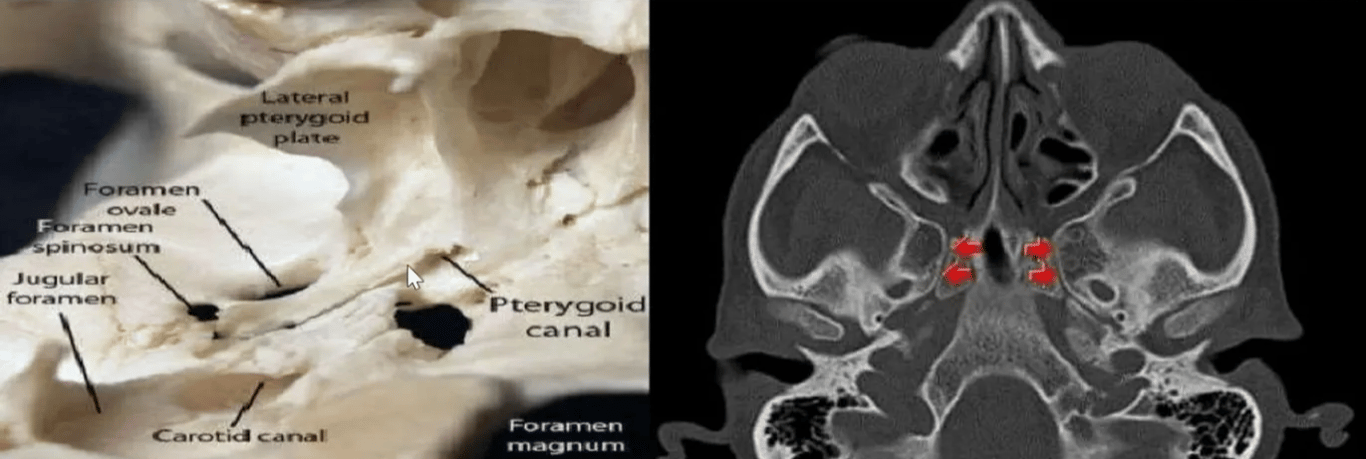 Vidian Canal # pterygoid canal. + Located in the floor of sphenoid sinus at the junction of the pterygoid process the sphenoid body connecting the pterygopalatine fossa ant & the foramen lacerum posteriorly. + Contents:- l) Vidian Artery ( Br. Of Maxillary Artery). + 2) Vidian Nerve (greater superficial petrosal nerve & deep petrosal nerve ) 