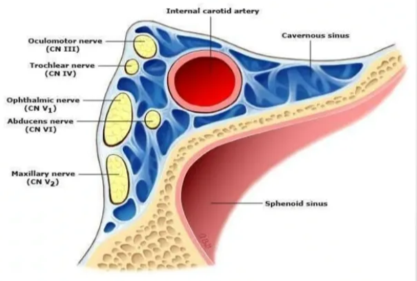 The contents & foramina's of MCF Cavemous Sinus + Situated on each side of the body of sphenoid bone & extend from sup. orbital fissure ant to petrous apex post. + Receives :- Sup.& inf. ophthalmic vein, Central vein of retina Sphenoparietal sinus. + Drains into:- Petrosal sinus, Pterygoid plexus, Basilar olexus. *Contents:- l) CN Ill, v,vl, V2 & VI 2) ICA Only anatomic _ jcation in th2 body in which an •_hrough 
