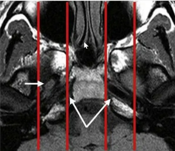 Central Skull base (Middle cranial fossa) • For diagnostic imaging purposes, it is useful to subdivide the CSB further into • midline sagittal, • off-midline parasagittal, and • lateral compartments by drawing vertical lines passing medially to the petroclival fissure and just lateral to the foramen ovale, respectively 