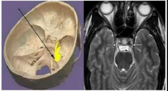 Meckers Cave # Dural invagination at posterior aspect Of cavernous sinus. Contains gasserian ganglion (trigeminal). + Dural layers shows thin peripheral enhancement. Optic canal + Formed by the lesser wing of sphenoid. + The contents are :- Optic nerve . Ophthalmic Artery. Sympathetic fibers from carotid plexus 
