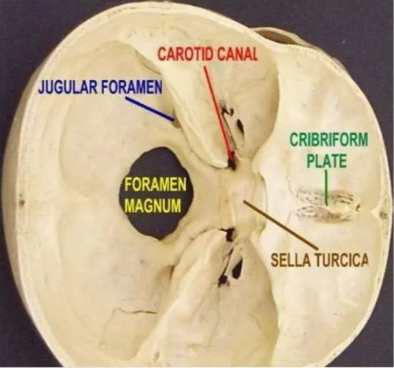 Carotid canal + It's a passage within petrous temporal bone & transmits the ICA & sympathetic plexus enters the MCF from the neck. Its initially directed superiorly, then turns anteromedially to reach up to the petrous apex. * It approximately runs 2cm and opens to foramen lacerurn. CAROTID CAW JUGULAR FORA%N FORAMEN MAGNUM CRIBRIFOU 