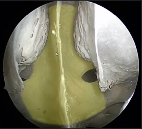 phen. Osti heno>al. S Vidian canal . proc. — 