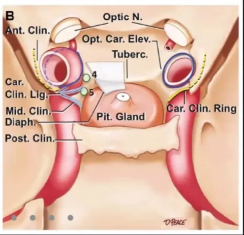 c LO R Clin. Lg Tuberc. Rec. 04 Car. Sellar Prom. Prom. Optic NC Ant. 1• Post in. t. Clin. Car. Mid. Clin. Diaph Post. Clin. Optic N. Opt. Car. Elev. Tuberc. 4 Pit. Gland ar. in. Ring 
