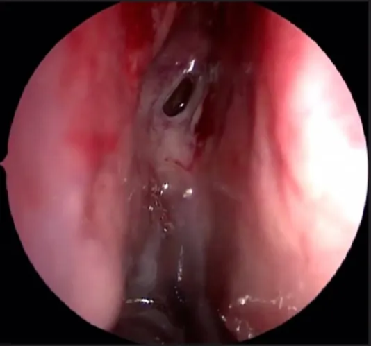 phen. Osti heno>al. S Vidian canal . proc. — 