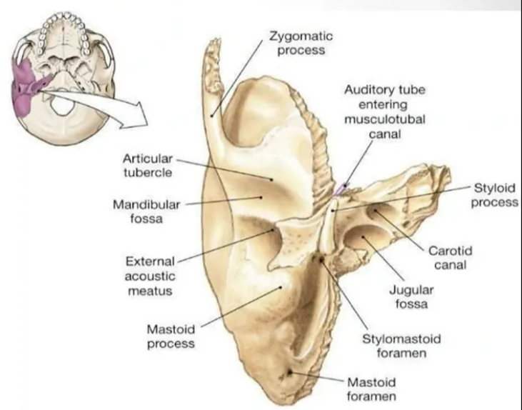 The Temporal bone 2. It is of pcyts: the mastoid, and i. Mast&d PMI is the posterior mos' part ot me temporal Cone. Its outer surtoce is roughened Oy rru.sculc• oracnments, bears an intenar conical æoBtian the mstoid which palpable just i'. Petrous Pan It is a of that and anfer&y from the part It a eony between the sprenoid and occipital bones wirnin cranial cavitn This parl divides 'he •Wddle and posterior cranial tossae. 