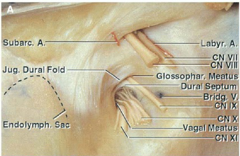 Posterior view of the intracranial aspect of the left jugular foramen