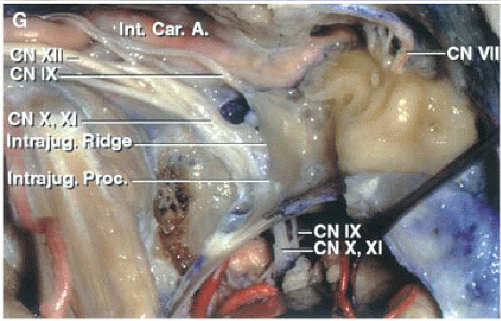 The medial venous wall of the jugular bulb has been removed. 