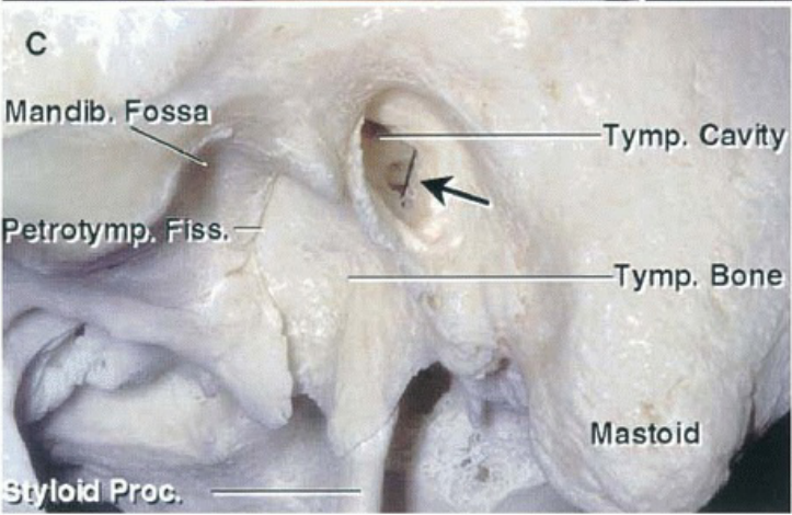 c Mandib. Fossm• troty od+roc. Tymp. Cavit Tymp. Bon Mastoid 