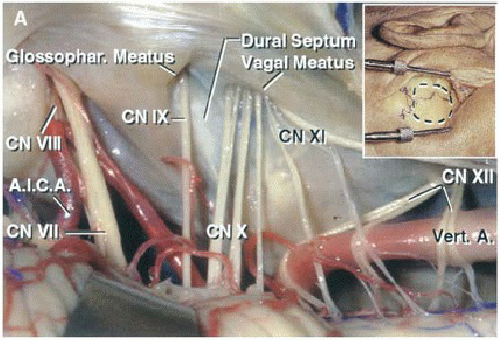 The detail shows the site of the vertical scalp incision and right retrosigmoid craniotomy.