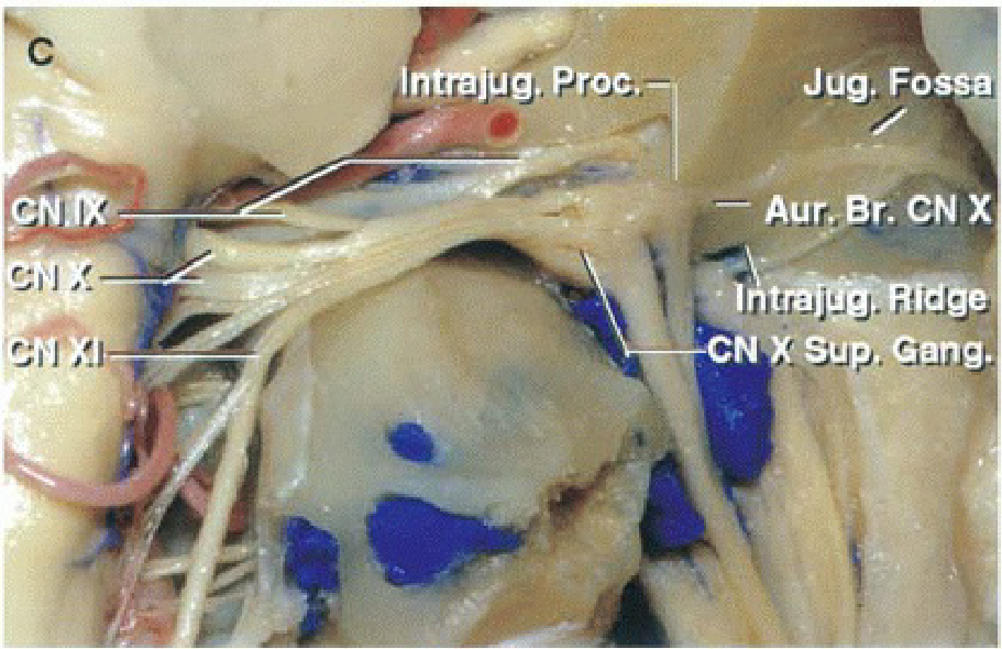 The dura covering the jugular foramen and the jugular bulb have been removed.
