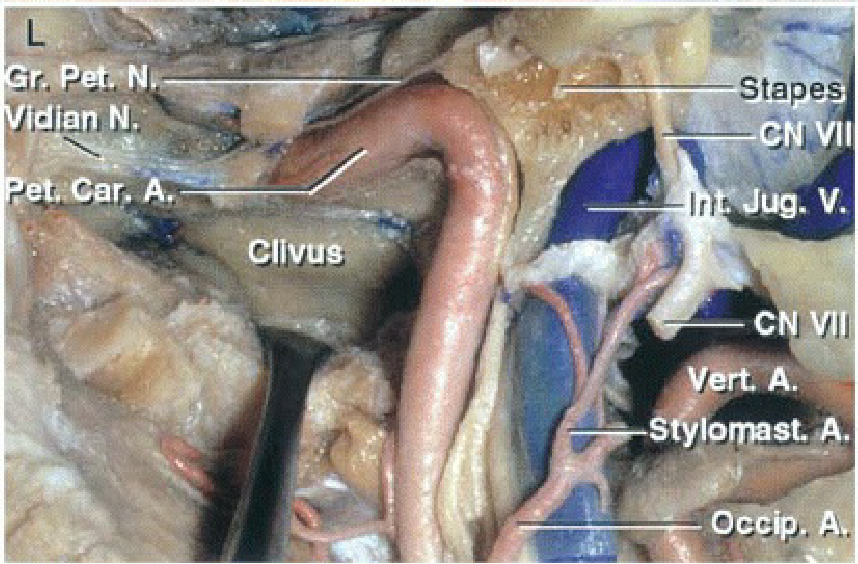 The floor of the middle fossa and the tympanic sulcus have been removed to expose the jugular bulb and petrous carotid.