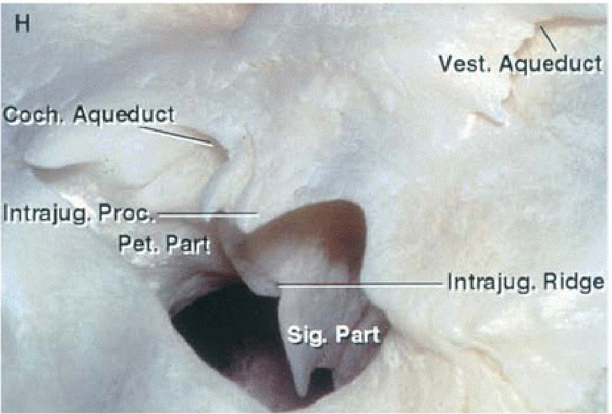 Coah. Aqueduct Intrajug, Pro Pet. Part. Vest. Aqueduct Intrajug. Ridge ig. Part 