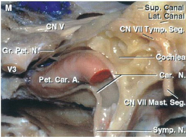 The jugular bulb has been removed from the jugular fossa located below the vestibule and semicircular canals. 