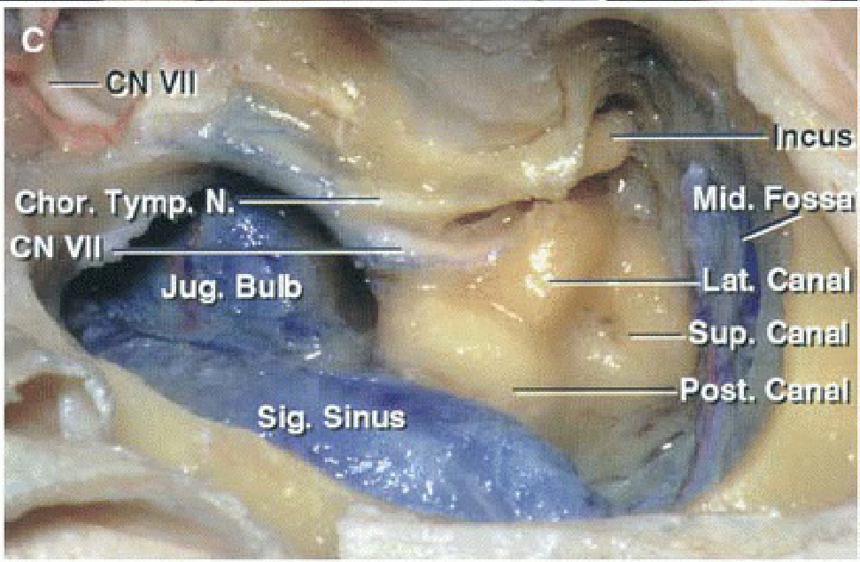 Enlarged view of the mastoidectomy.