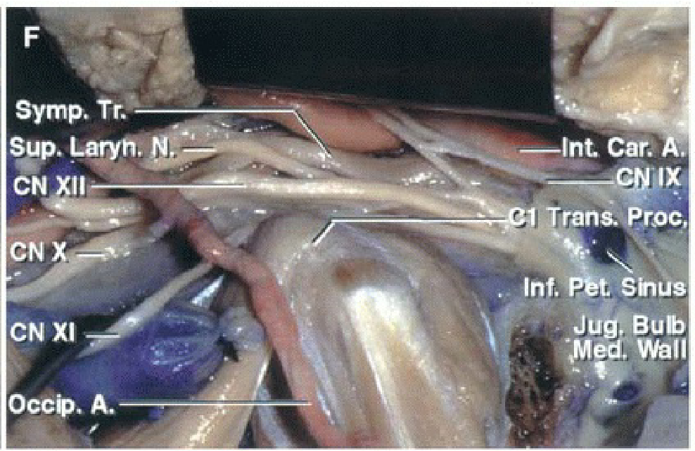 A segment of the sigmoid sinus, jugular bulb, and internal jugular vein have been removed.