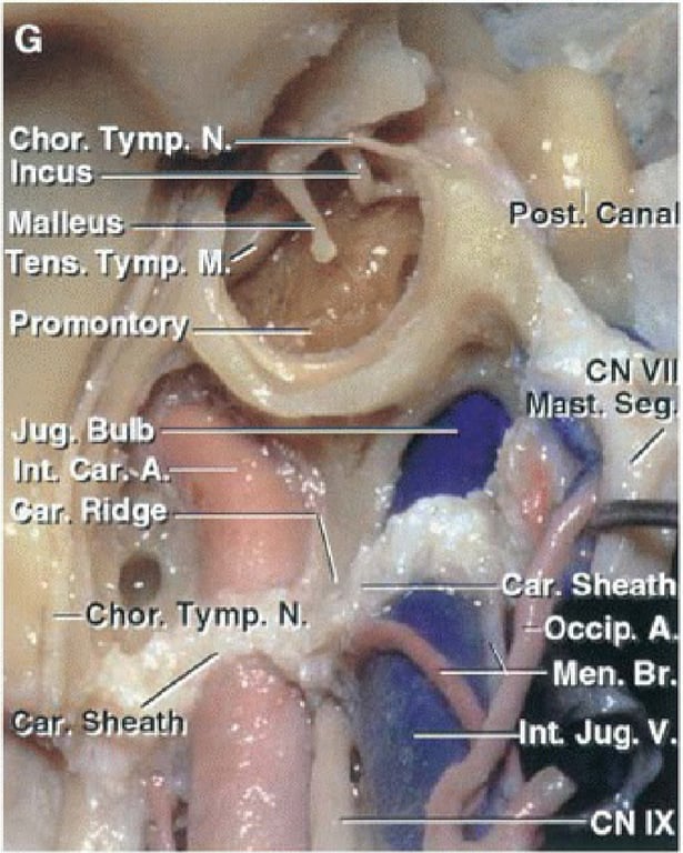 Chor. Incus Malleus Tens. TYTp. Promontory Jug Bub Ridge —Ch r. Tymp. N. Post. Can CNV Men. Br. nt Jug. V. 