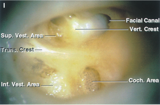 Sup. Vest. Crest— Inf. Vest. Area Facial Canal Vert Crest Coch. Area 